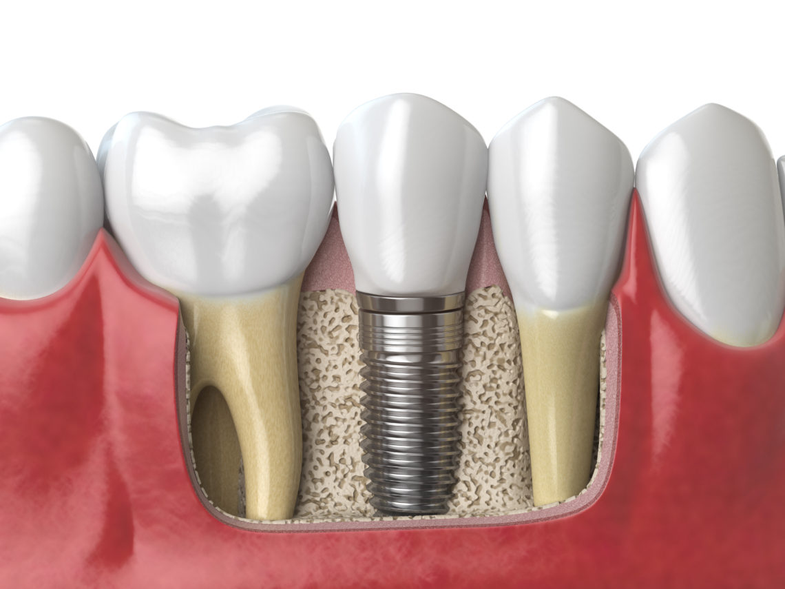 An Overview Of Dental Implants Centres, Singapore!